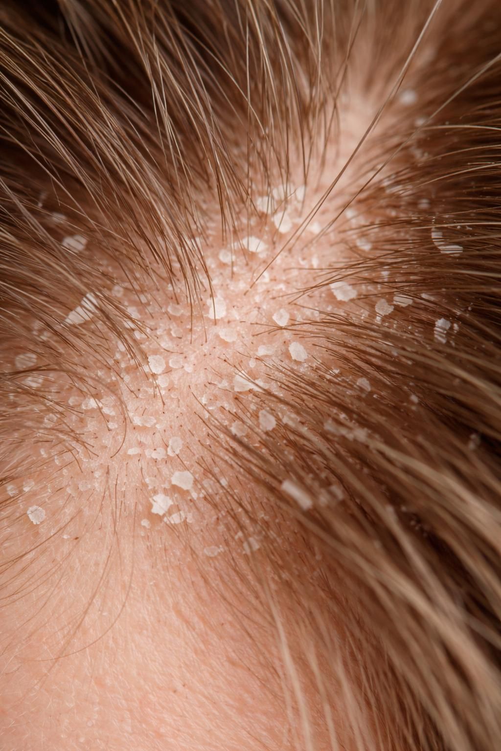 découvrez les causes des squames et pourquoi ces petites peaux mortes envahissent votre cuir chevelu, ainsi que des conseils pour les prévenir et les traiter efficacement.